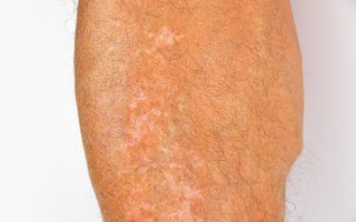 蛇缠腰疱疹怎么治疗好得快？实用方法分享不藏私【蛇缠腰疱疹怎么治疗好得快会传染吗】